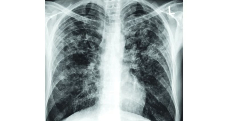 الصحة تعزز جهود مكافحة مرض السل وتواصل الحفاظ على معدلات إصابة منخفضة