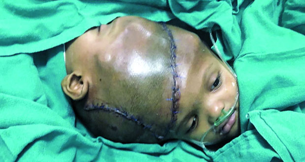 جراحة ناجحة بالهند لفصل توأمين ملتصقين عند الرأس