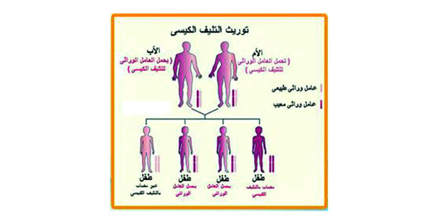التليف الكيسي.. مرض وراثي يصيب الأطفال يسببه جين يحمله الوالدان
